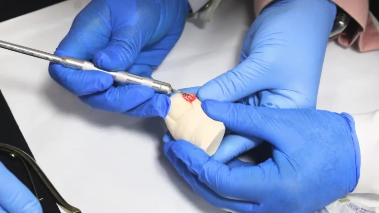 Onicocriptose com Granuloma